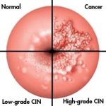 squamous intraepithelial lesion