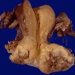 cancer of the cervixremoved through hysterectomy