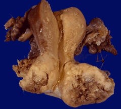 cancer of the cervixremoved through hysterectomy