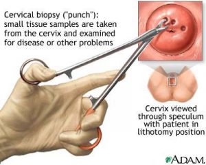 cervical biopsy